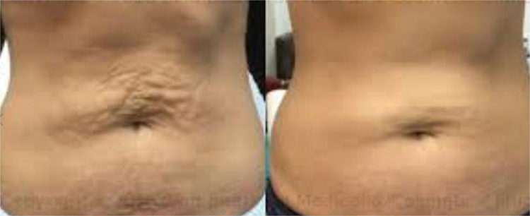 Before And After Pdo Thread Lift Abdomen(1)