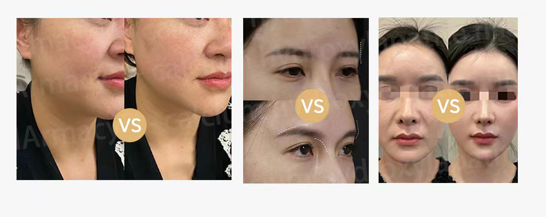 CHArmacy Calcium Filler before and after