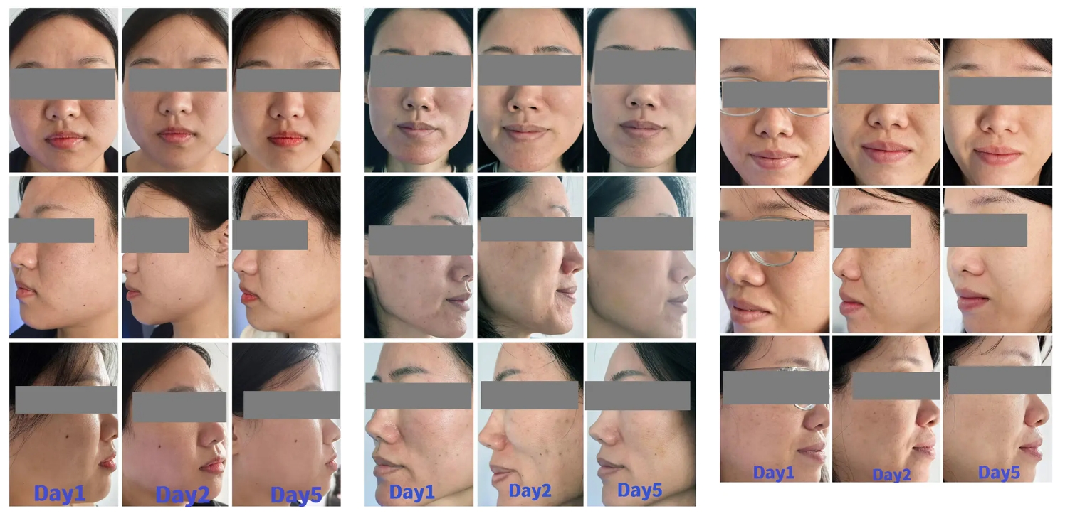 Mesocel Mesotherapy for Face Before and After
