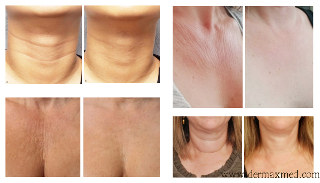 decolletage anti wrinkle