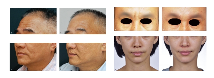 NutriDerm HYDRATE Skin Booster For Eye