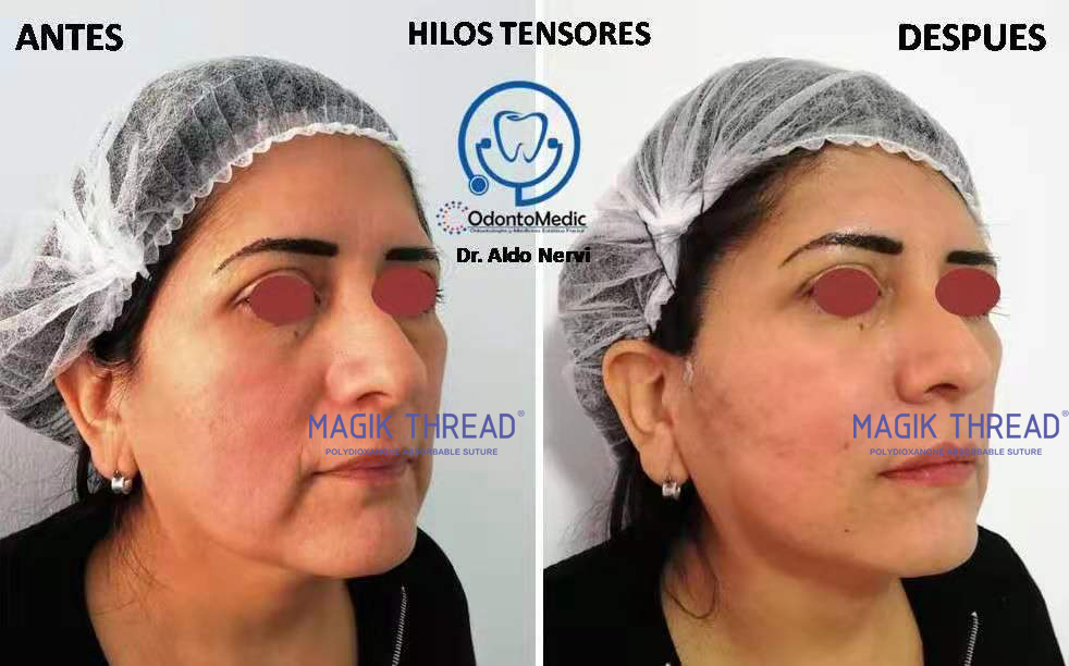 PDO Thread Lift Jawline Before and After (1)