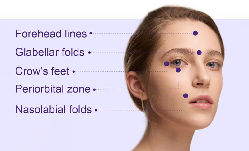 botulax 100U treatment areas