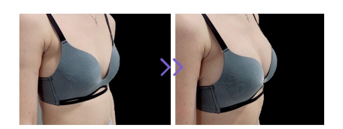 Devolux Plus breast filler before & after (2)