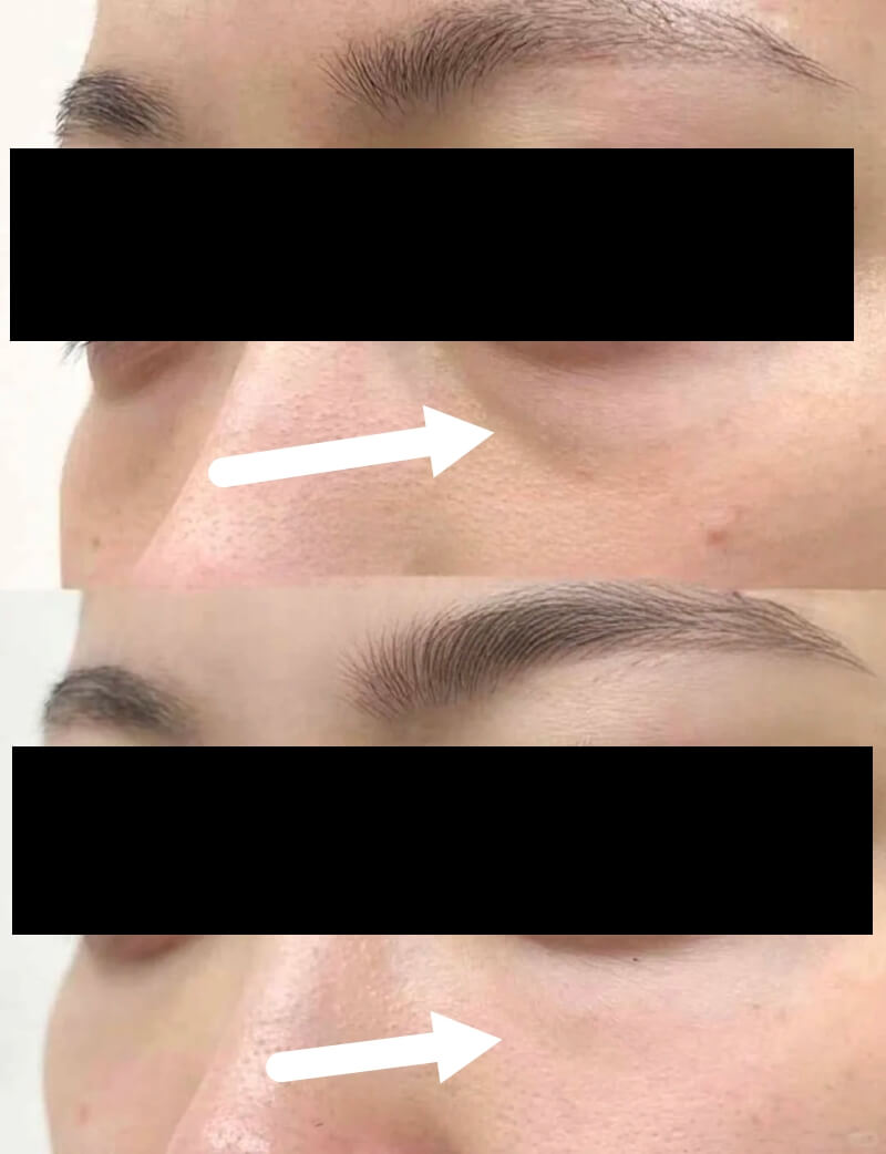 exosomes microneedling before and after