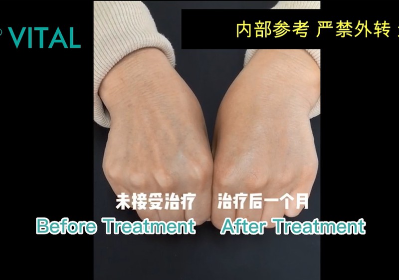 Devolux Dermal Filler for Hands Before and After Photos
