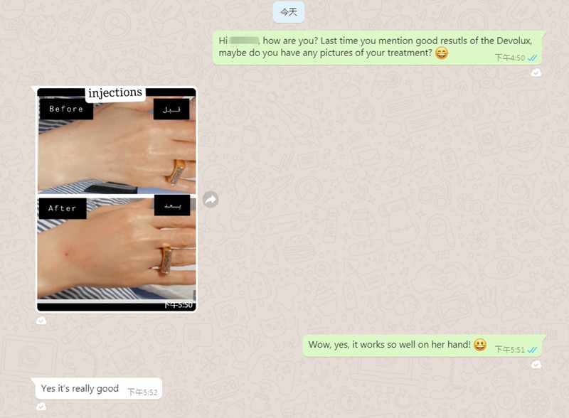 Devolux Dermal Filler for Hands Before and After Photos