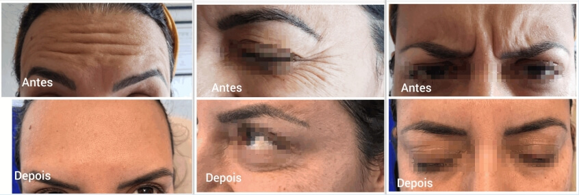 Nabota 200u Before and After (2)