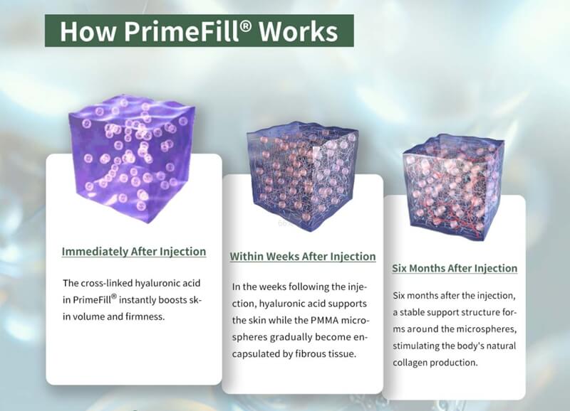 How PrimeFill PMMA Injections Works