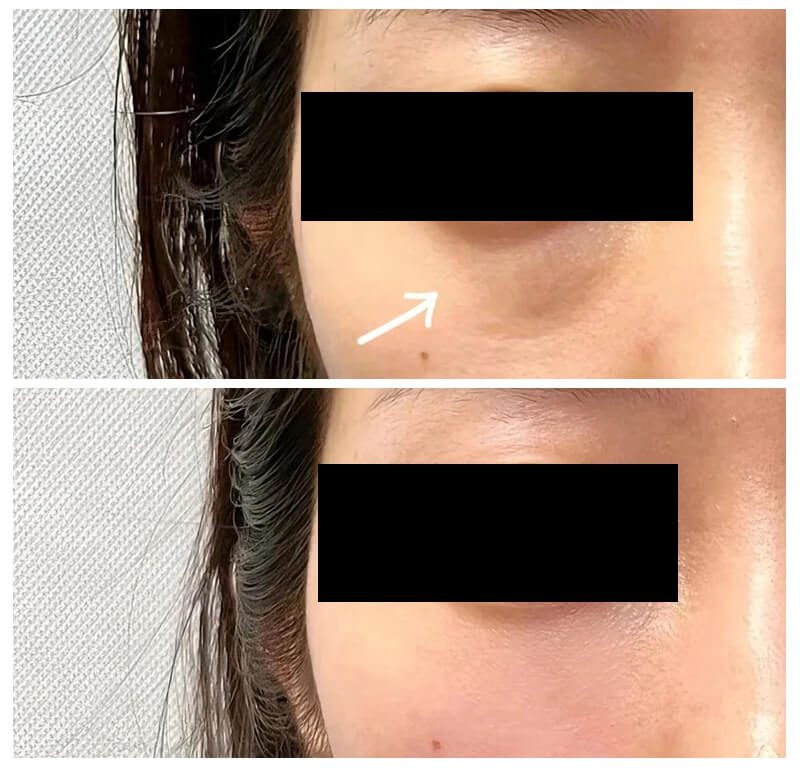 exosome skin booster before and after