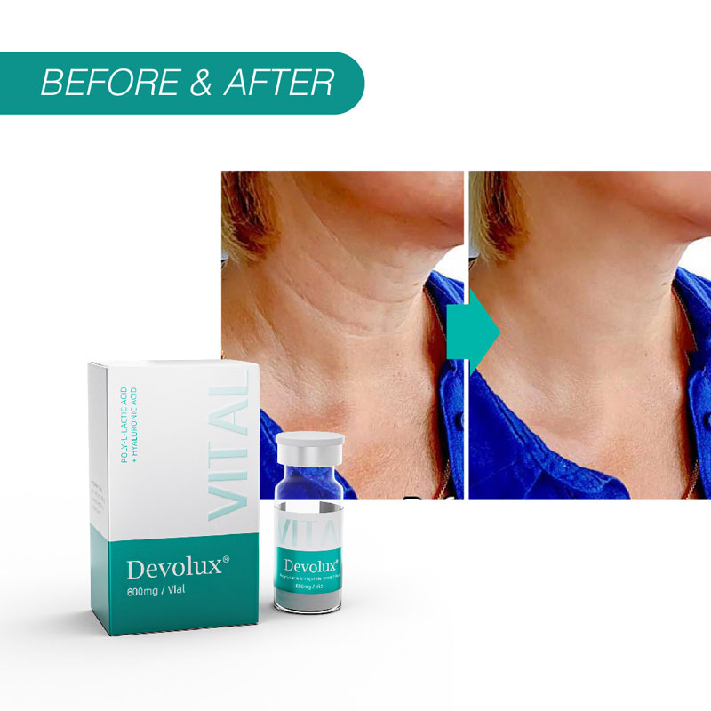 Neck rejuvenation before and after with Devolux&reg; Vital PLLA filler