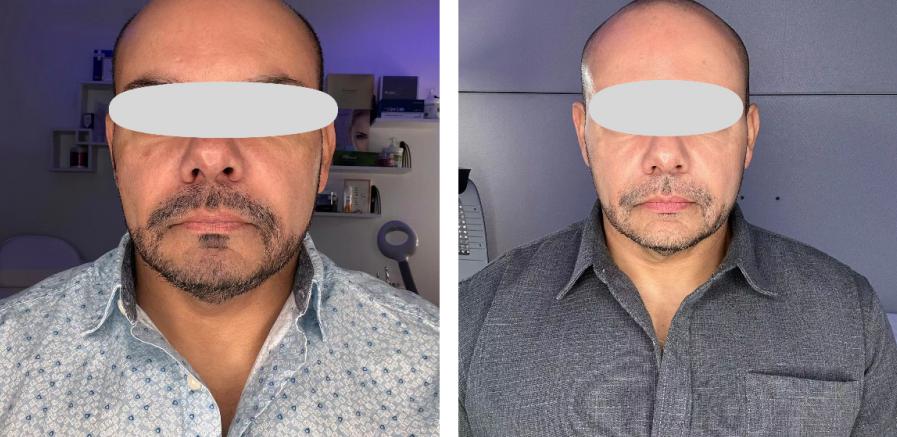 Prejvua hyaluronic acid skin booster before after