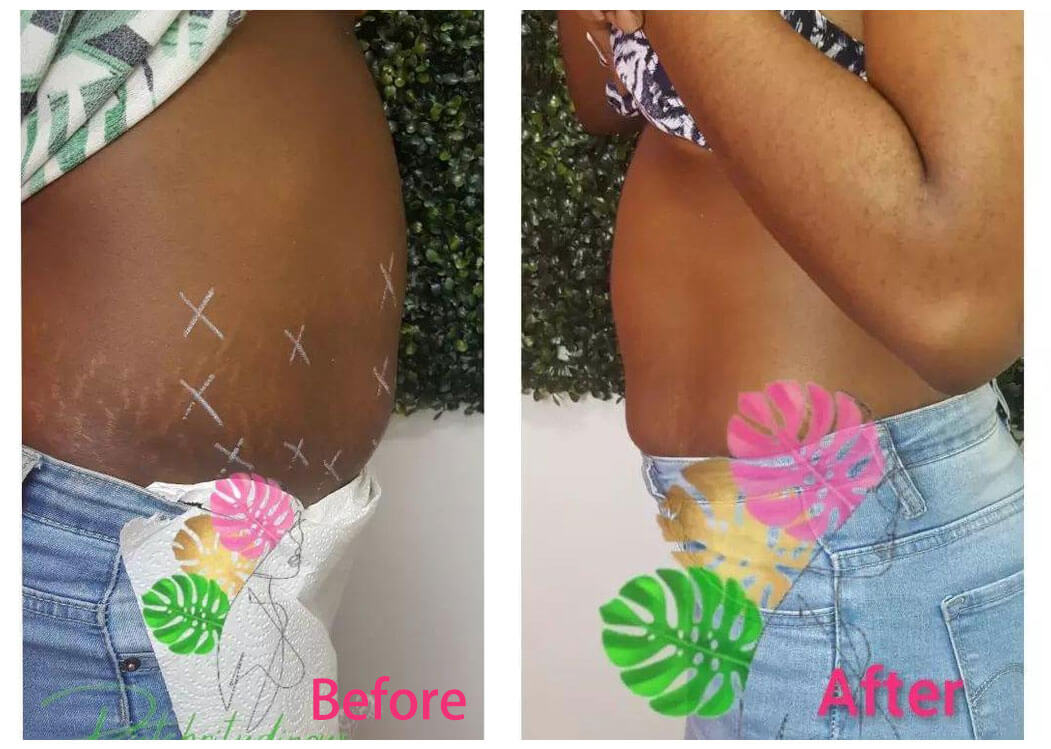 fat dissolving injections before and after (2)