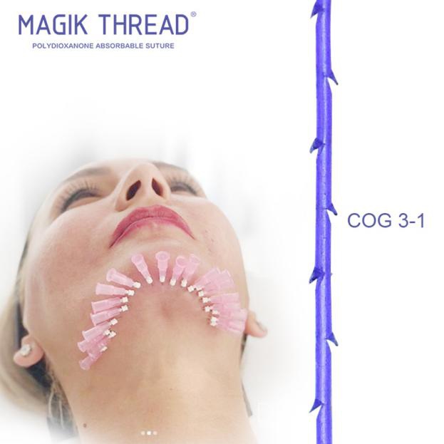 Do You Need a PDO Thread Lift (3)