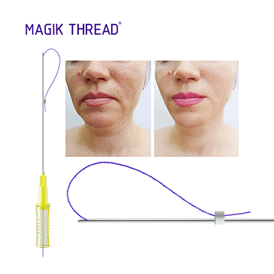 To create a small V face, the first choice is Magik Thread—cog