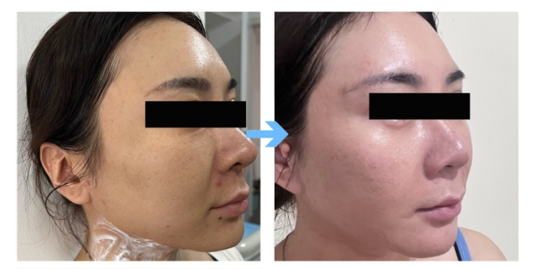 Calcium Hydroxylapatite Filler Before And After (2)