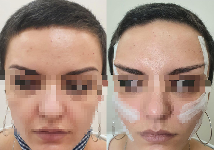 Pdo-Thread-Brow-Lift-Before-And-After