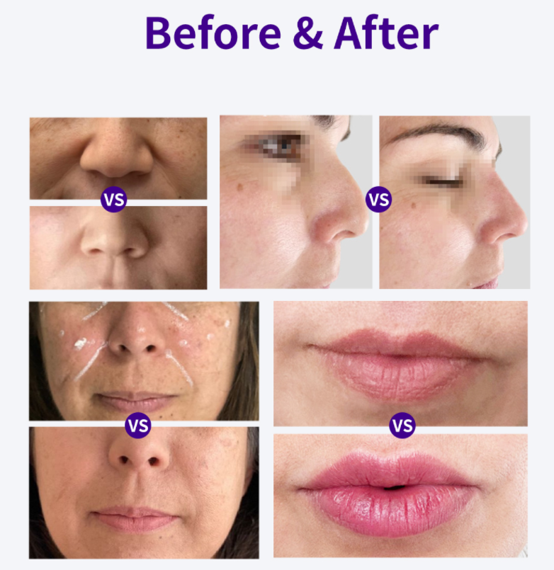 Best Dermal Filler For Face