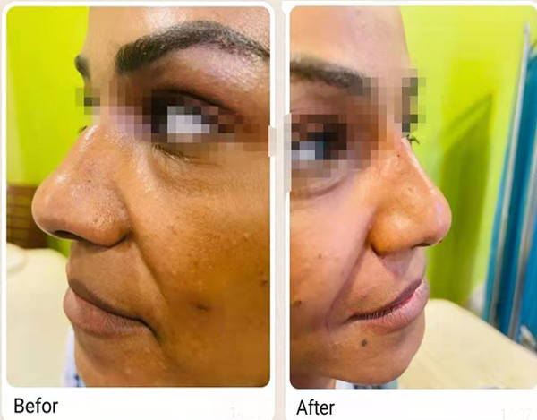 Polydioxanone Suture Pdo Thread Nose