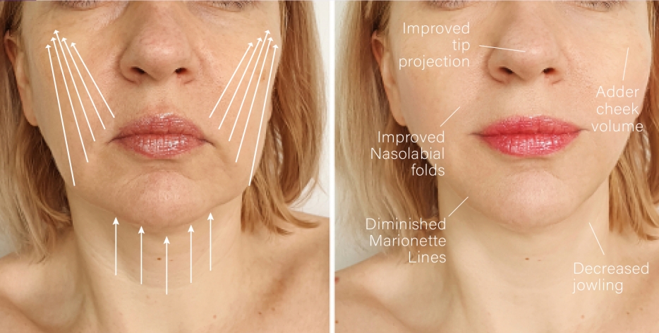 Hilos de PDO Antes y Después