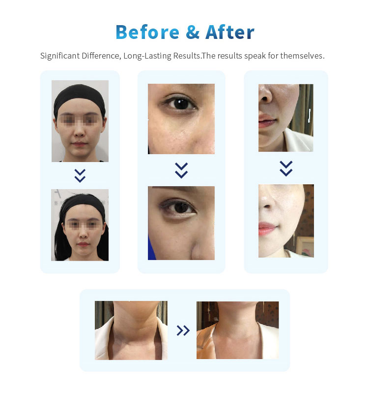 Devolux Poly l Lactic Acid Filler before and after