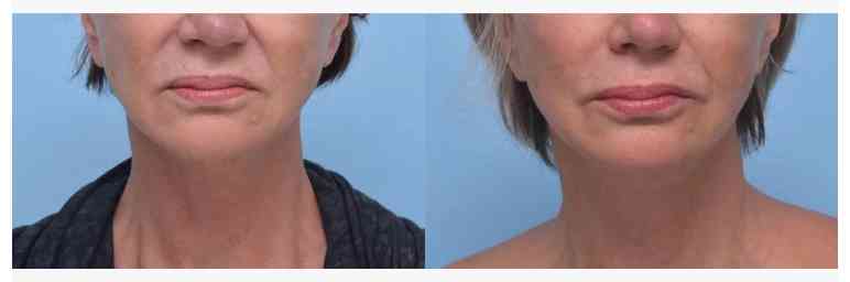 Sotorior Botulinum Toxin for Smile Lines before after 2