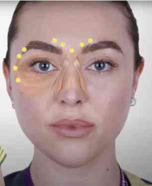Eyebrow Lift Sotorior Botulinum Toxin Injection Sites