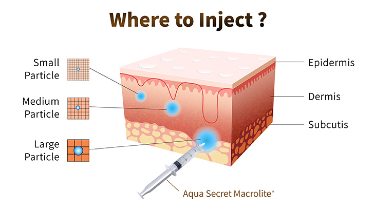 Dermal filler for big butt enlargement 2