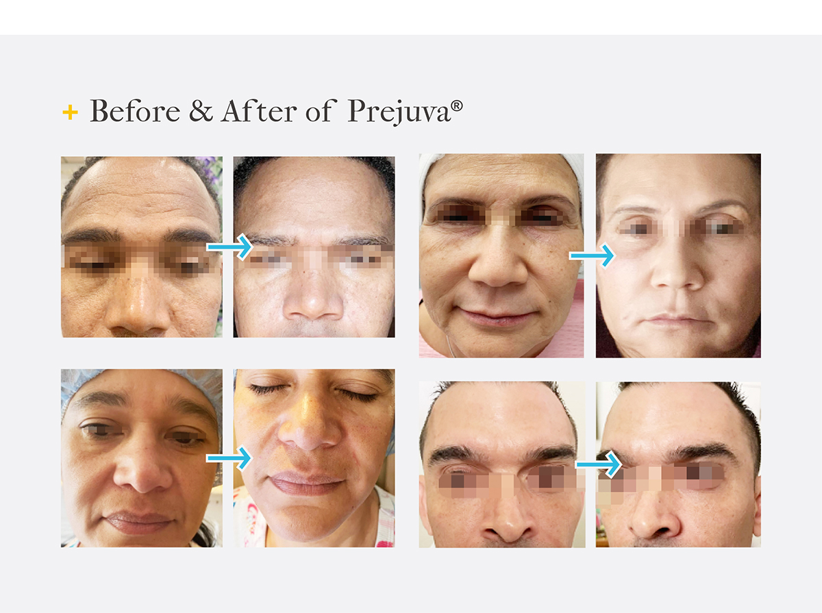 profhilo injections before and after