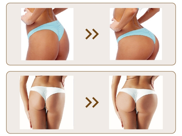 Buttock Hyaluronic Acid Injections before and after