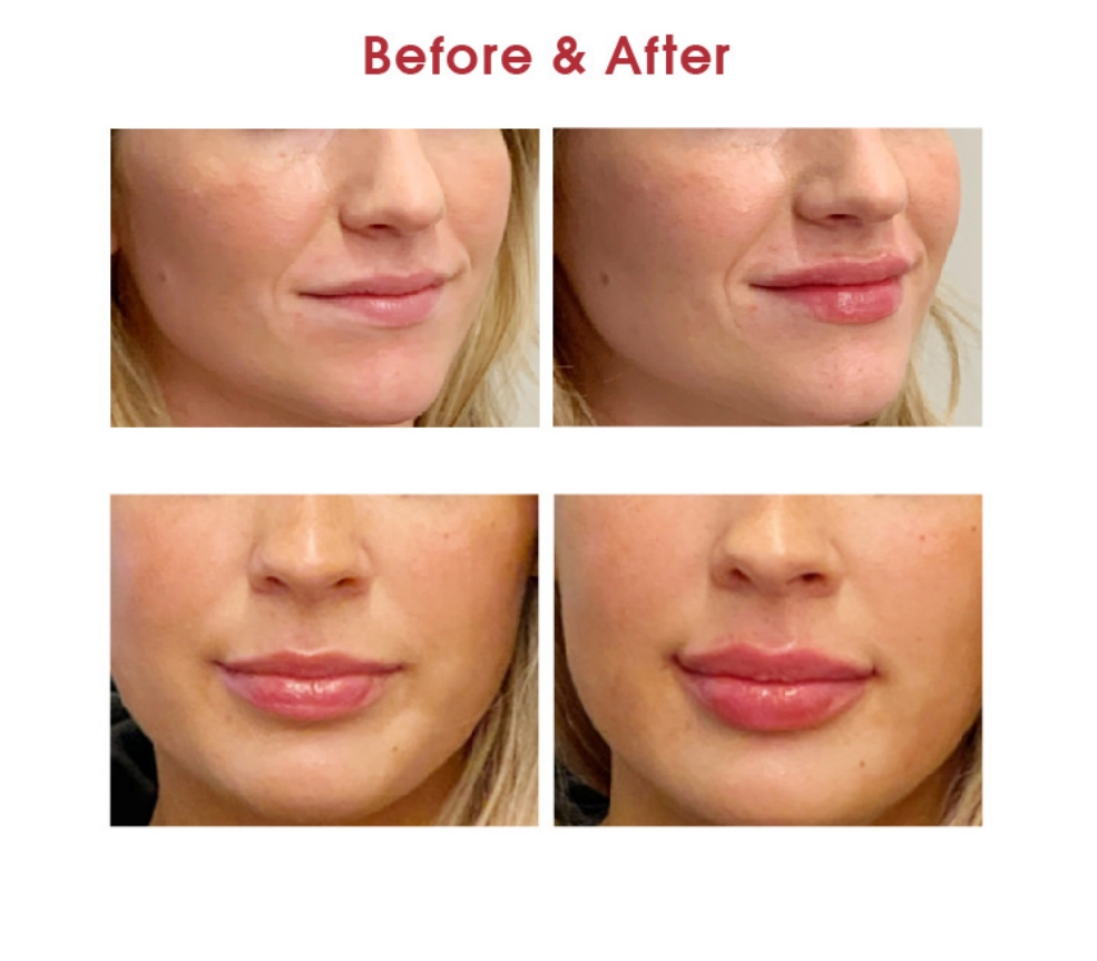 buy lip injections online