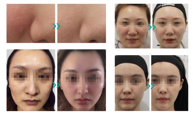 Devolux PLLA biostimulators