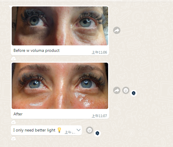 hyaluronic acid filler before and after