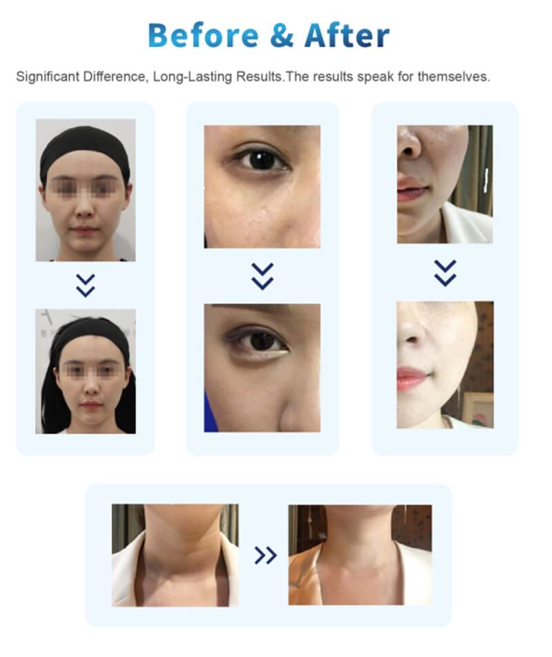 PLLA Filler Before And After