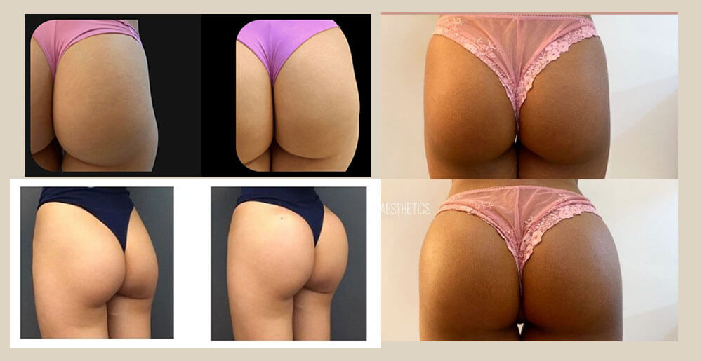 What is Macrolite Hyaluronic Acid Buttock Filler (2)