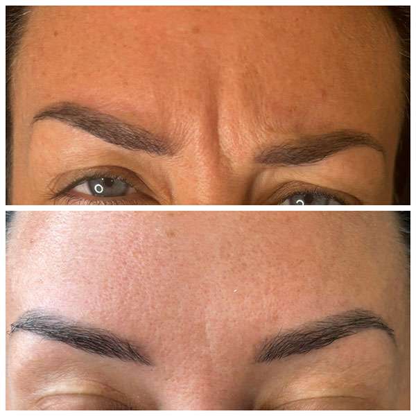 Sotorior Botulinum Toxin Type A 100 Units Price