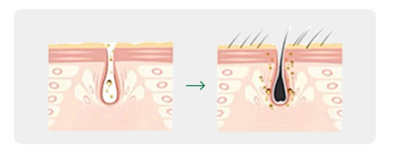 exosome hair therapy