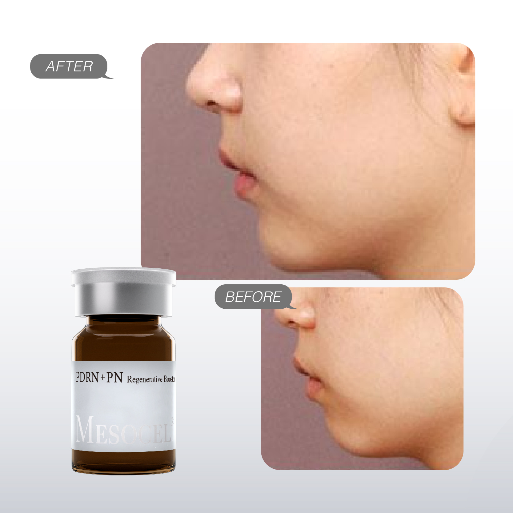What is PDRN Therapy? Salmon DNA for Skin regeneration and repair 