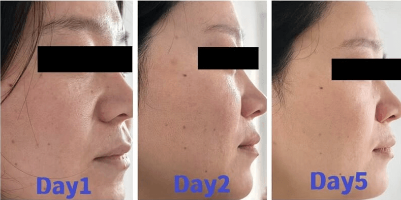 before and after exosomes 