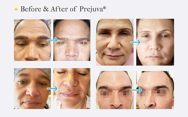 Prejuva HA Skin Booster before and after (2)
