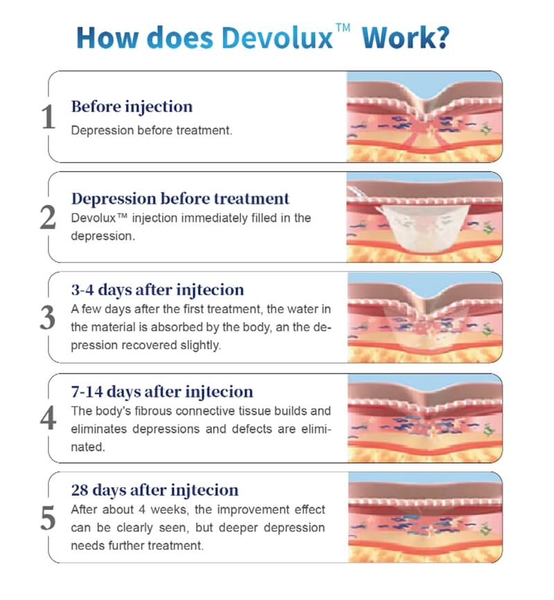 how deose devolux plla filler work