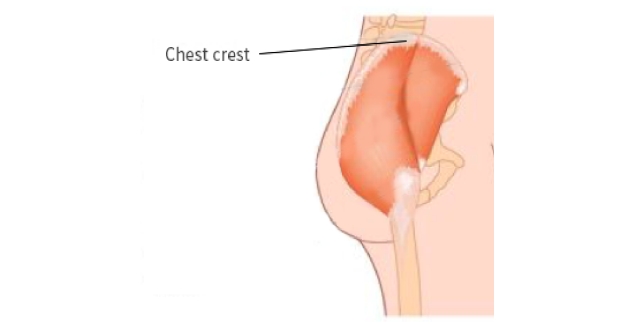 breast filler injection site