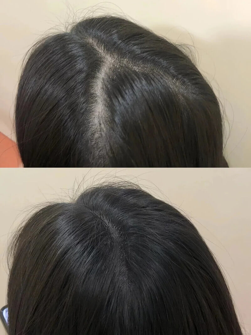 mesotherapy for hair before and after