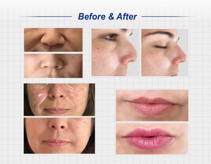 Revisage&reg; Hyaluronic Acid Filler