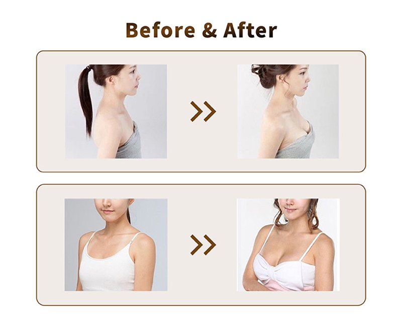 Hyaluronic Acid Breast Filler