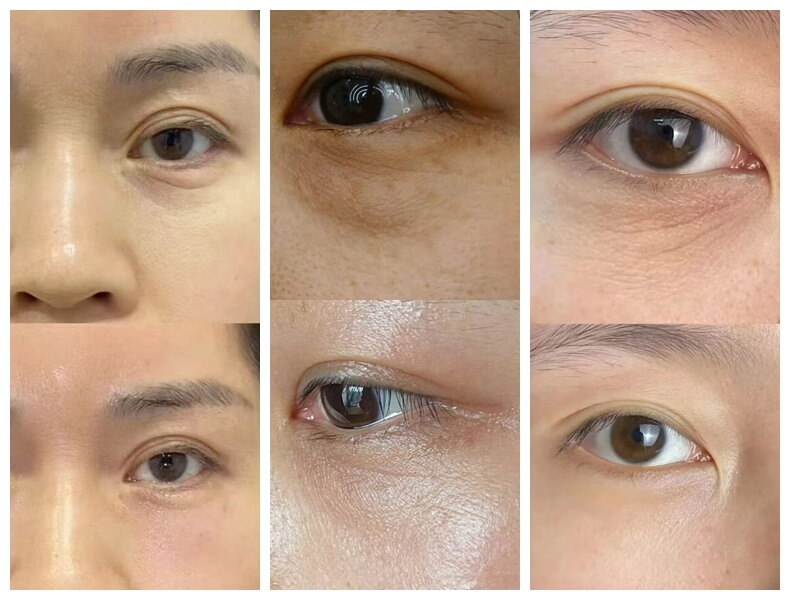 benefits of polynucleotides under eyes