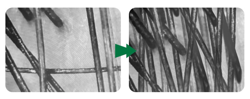 mesotherapy for hair loss before and after pictures