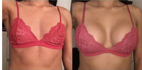 plla buttock injections before and after