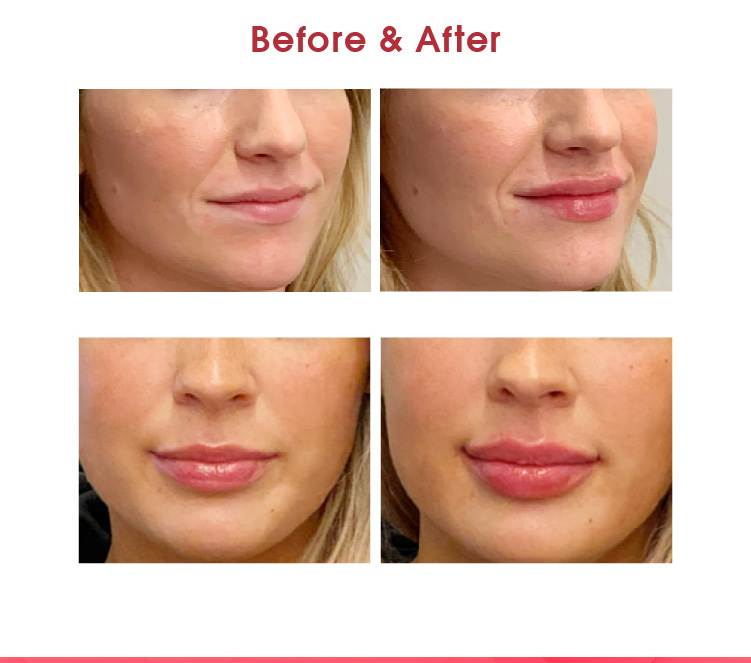 Aqua Secret&reg; Smoocy lip filler before and after