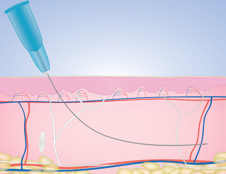 What Is The Cost Of The Pdo Thread Lift? Dermax